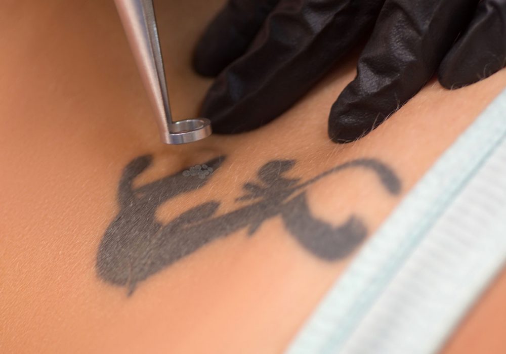 Tattoo compensation claims