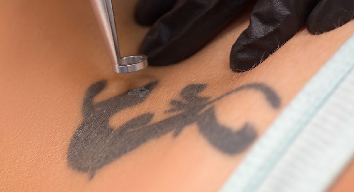 Tattoo compensation claims