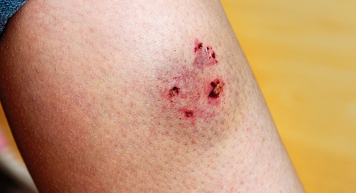 Dog bite injury compensation claims